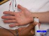 Median Sensory Nerve Conduction Study, recording the index finger (antidromic)