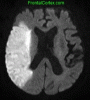 Right MCA stroke