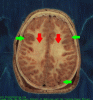 Grey Matter vs White Matter