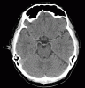 CT Circle of willis