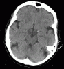 CT dense MCA