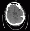 Normal head CT, for comparison