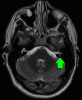 MRI T2 semicircular canals