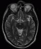 MRI T2 MCA ACA normal