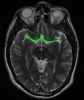 T2 MRI MCA ACA highlighted