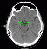 CT Circle of Willis highlighted