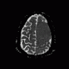 MRI ADC meningioma