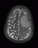 MRI T2 meningioma