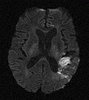 MRI Fluent Aphasia