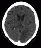 CT left PCA stroke