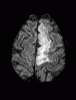 MRI DWI left ACA stroke