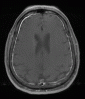 MRI - Enhancing Meninges