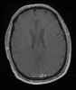 MRI - normal meninges for comparison