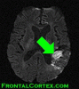 MRI Fluent Aphasia with arrow