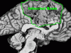 ACA infarct sagittal labeled