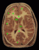 Horizontal slice of gross brain