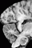 Early Alzheimer's disease, sagittal section of brain and brainstem