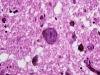 Alzheimer's disease, globose neurofibrillary tangle within the locus ceruleus