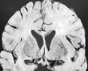 Coronal section