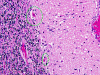 Acute neuronal necrosis cerebellum 2