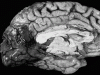 PCA stroke, medial surface of brain