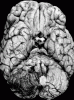 Hemorrhagic infarct, posterior inferior cerebellar artery distribution, ventral surface of brain.