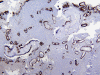 Amyloid Angiopathy, immunohistochemical staining for beta amyloid, low power.