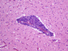 Primary angiitis of the central nervous system, low power H&E stained section