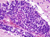 Primary angiitis of the central nervous system, high power H&E stained slide