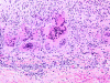 Giant cell arteritis involving temporal artery, high power H&E stained slide