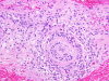 Primary angiitis of the central nervous system, leptomeningeal blood vessel, high power H&E