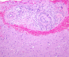 Primary angiitis of the nervous system, low power H&E stained section including leptomeninges