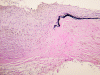 Aneurysm wall, histochemical staining for elastin.