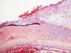 Aneurysm wall, high-power movat pentachrome stain.