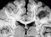 Arteriovenous valve formation, coronal section through parietal lobe