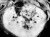 Foix-Alajounine syndrome, transverse section through spinal cord.