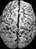 Alzheimer disease, dorsal surface of brain.