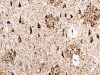 Alzheimer's disease, tau immunohistochemical stain, neocortex x 200