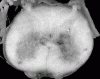 Kugelberg Welander Transverse Spinal Cord