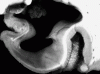 Frontotemporal lobar degeneration, coronal section of medial temporal lobe, close-up