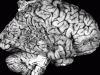 Posterior   Lobar atrophy, lateral surface of brain