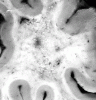 Binswanger disease, coronal section through frontal pole.