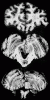 Olivopontocerebellar Atrophy, coronal section through frontal lobe and transverse sections through pons, medulla, and cerebellum.