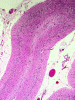 Spinocerebellar atrophy, H&E section through cerebellar folia x 40