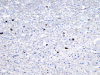 Multiple system atrophy, alpha synuclein immunohistochemical staining within dentate nucleus of cerebellum.