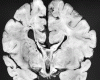 Septo-optic dysplasia, coronal section through brain at the level of the foramen of Monro