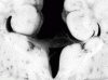 Agenesis of the corpus callosum, coronal section through neonatal brain, close-up