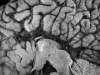 Agenesis of the corpus callosum, mid sagittal section through brain, close-up