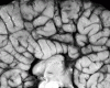 Agenesis of the corpus callosum, mid sagittal view, close-up