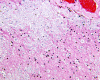 Amygdala, high power H&E stain demonstrating innumerable corpora amylacea.